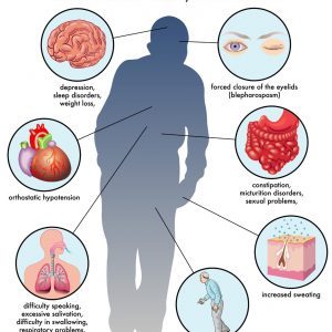 Illustration of Parkinson’s Disease Symptoms Used by a Neurologist