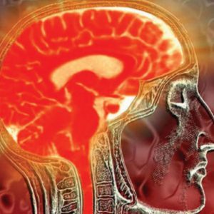 Alz Brain | Neurology Associates VA